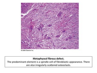 Metaphyseal fibrous defect.
The predominant element is a spindle cell of fibroblastic appearance. There
are also irregularly scattered osteoclasts.
 