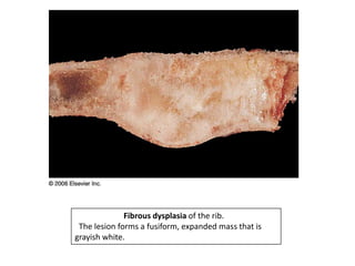 Fibrous dysplasia of the rib.
The lesion forms a fusiform, expanded mass that is
grayish white.
 
