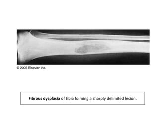 Fibrous dysplasia of tibia forming a sharply delimited lesion.
 