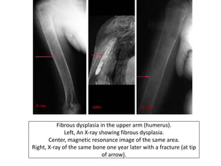 Fibrous dysplasia in the upper arm (humerus).
Left, An X-ray showing fibrous dysplasia.
Center, magnetic resonance image of the same area.
Right, X-ray of the same bone one year later with a fracture (at tip
of arrow).
 