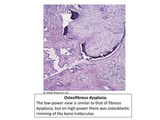 Osteofibrous dysplasia.
The low-power view is similar to that of fibrous
dysplasia, but on high power there was osteoblastic
rimming of the bone trabeculae.
 
