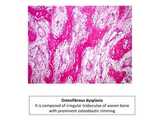 Osteofibrous dysplasia
It is composed of irregular trabeculae of woven bone
with prominent osteoblastic rimming
 