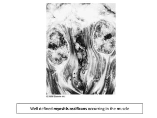 Well defined myositis ossificans occurring in the muscle
 