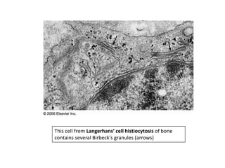 This cell from Langerhans’ cell histiocytosis of bone
contains several Birbeck's granules (arrows)
 