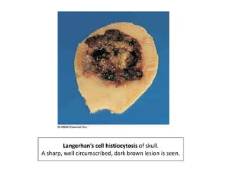 Langerhan’s cell histiocytosis of skull.
A sharp, well circumscribed, dark brown lesion is seen.
 