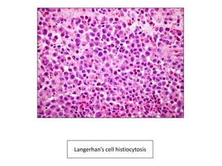 Langerhan’s cell histiocytosis
 