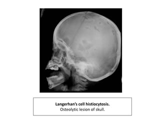 Langerhan’s cell histiocytosis.
Osteolytic lesion of skull.
 