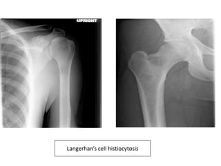 Langerhan’s cell histiocytosis
 