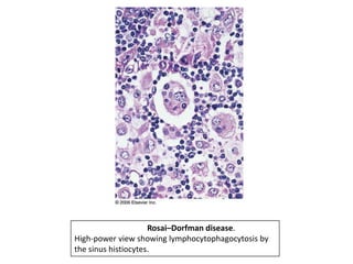 Rosai–Dorfman disease.
High-power view showing lymphocytophagocytosis by
the sinus histiocytes.
 