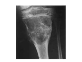 Tumor like lesions of bone | PPTX