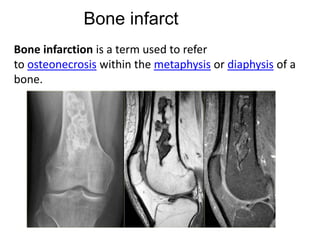 Tumor like lesions of bone | PPTX