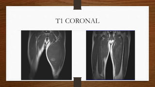 T1 CORONAL
 