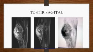 T2 STIR SAGITAL
 