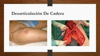 Desarticulación De Cadera
 