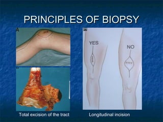 Tumor mega prosthesis | PPT