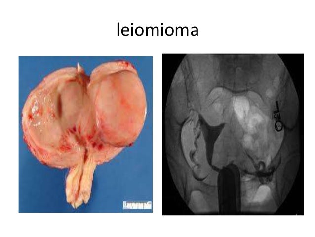 Tumor muskuloskletal