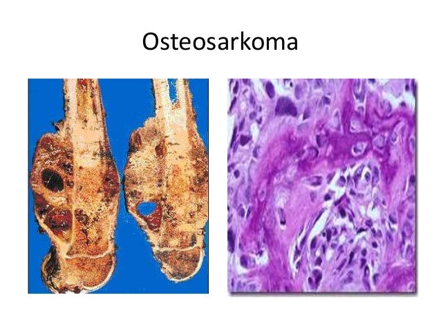 Tumor muskuloskletal