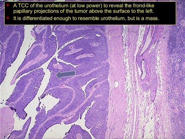 Tumor of kidney and urinary tract