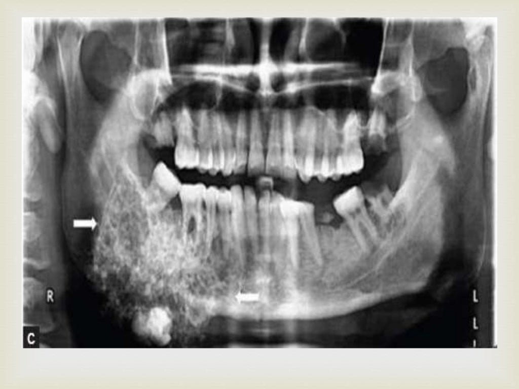 Tumor of oral cavity