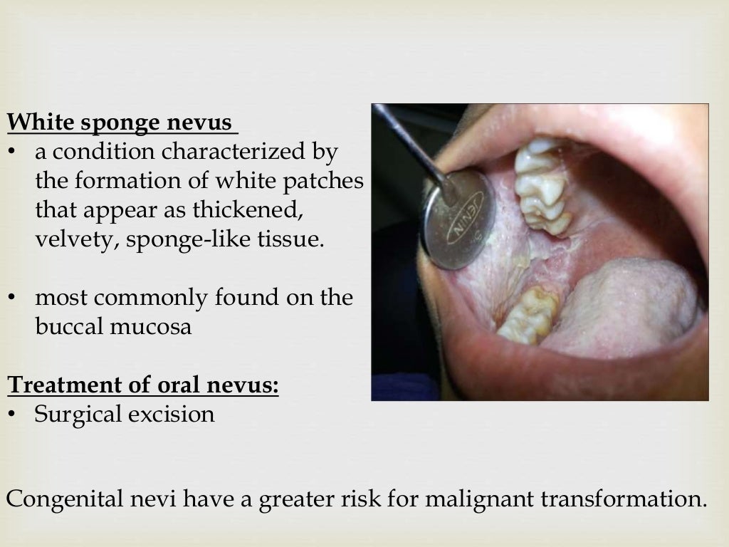 Tumor of oral cavity