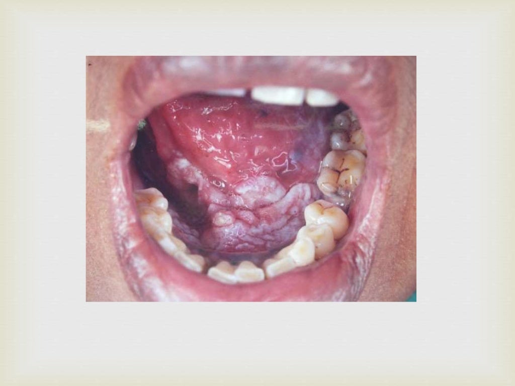 Tumor of oral cavity