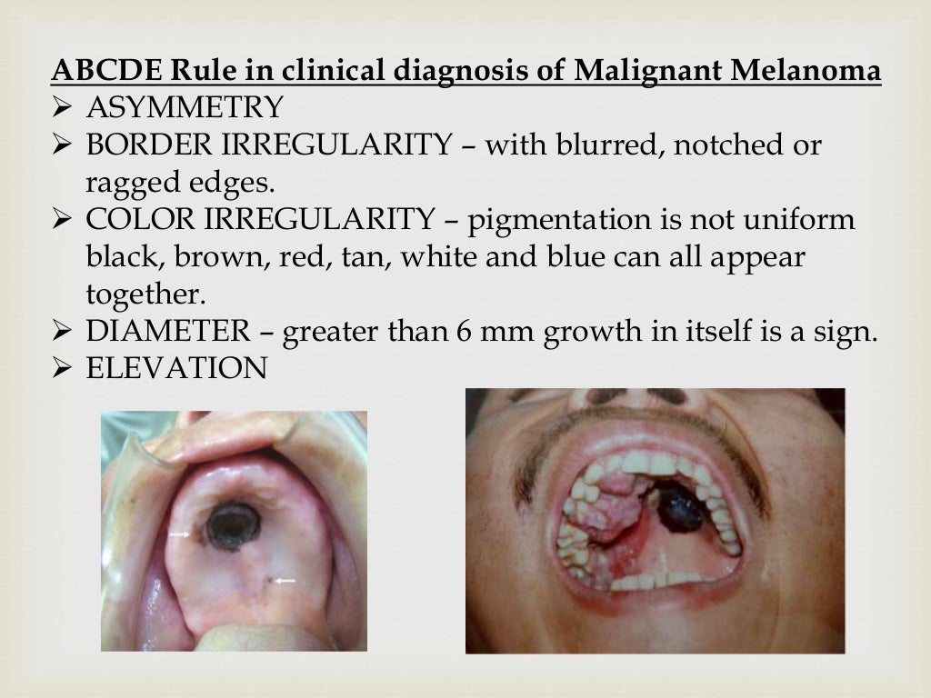 Tumor of oral cavity