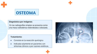 OSTEOMA
Tratamiento:
● Consiste en la resección quirúrgica
● Indicada solamente en pacientes con
síntomas clínicos o por razones estéticas.
Diagnóstico por imágenes
En las radiografías simples se presenta como
una masa radiodensa redondeada o lobulada.
 