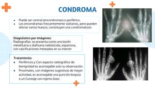 Tratamiento:
● Periféricos y Con aspecto radiográfico de
benignidad es aconsejable solo su observación.
● Proximales, con imágenes sugestivas de mayor
actividad, es aconsejable una punción-biopsia
o un Curetaje con injerto óseo.
CONDROMA
Diagnóstico por imágenes:
Radiografías: se presenta como una lesión
metafisaria o diafisaria radiolúcida, expansiva,
con calcificaciones moteadas en su interior
● Puede ser central (encondromas) o periférico.
● Los encondramas frecuentemente solitarios, pero pueden
afectar varios huesos; constituyen una condromatosis
 