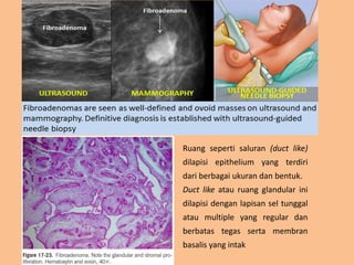 Ruang seperti saluran (duct like)
dilapisi epithelium yang terdiri
dari berbagai ukuran dan bentuk.
Duct like atau ruang glandular ini
dilapisi dengan lapisan sel tunggal
atau multiple yang regular dan
berbatas tegas serta membran
basalis yang intak
 