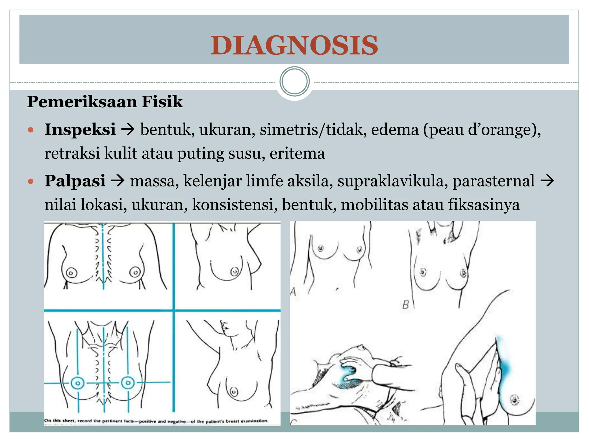 DIAGNOSIS
Pemeriksaan Fisik
 Inspeksi  bentuk, ukuran, simetris/tidak, edema (peau d’orange),
retraksi kulit atau puting susu, eritema
 Palpasi  massa, kelenjar limfe aksila, supraklavikula, parasternal 
nilai lokasi, ukuran, konsistensi, bentuk, mobilitas atau fiksasinya
 