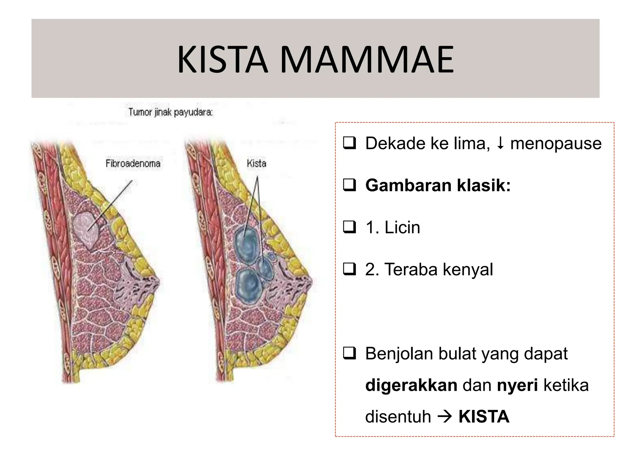  Dekade ke lima,  menopause
 Gambaran klasik:
 1. Licin
 2. Teraba kenyal
 Benjolan bulat yang dapat
digerakkan dan nyeri ketika
disentuh  KISTA
KISTA MAMMAE
 