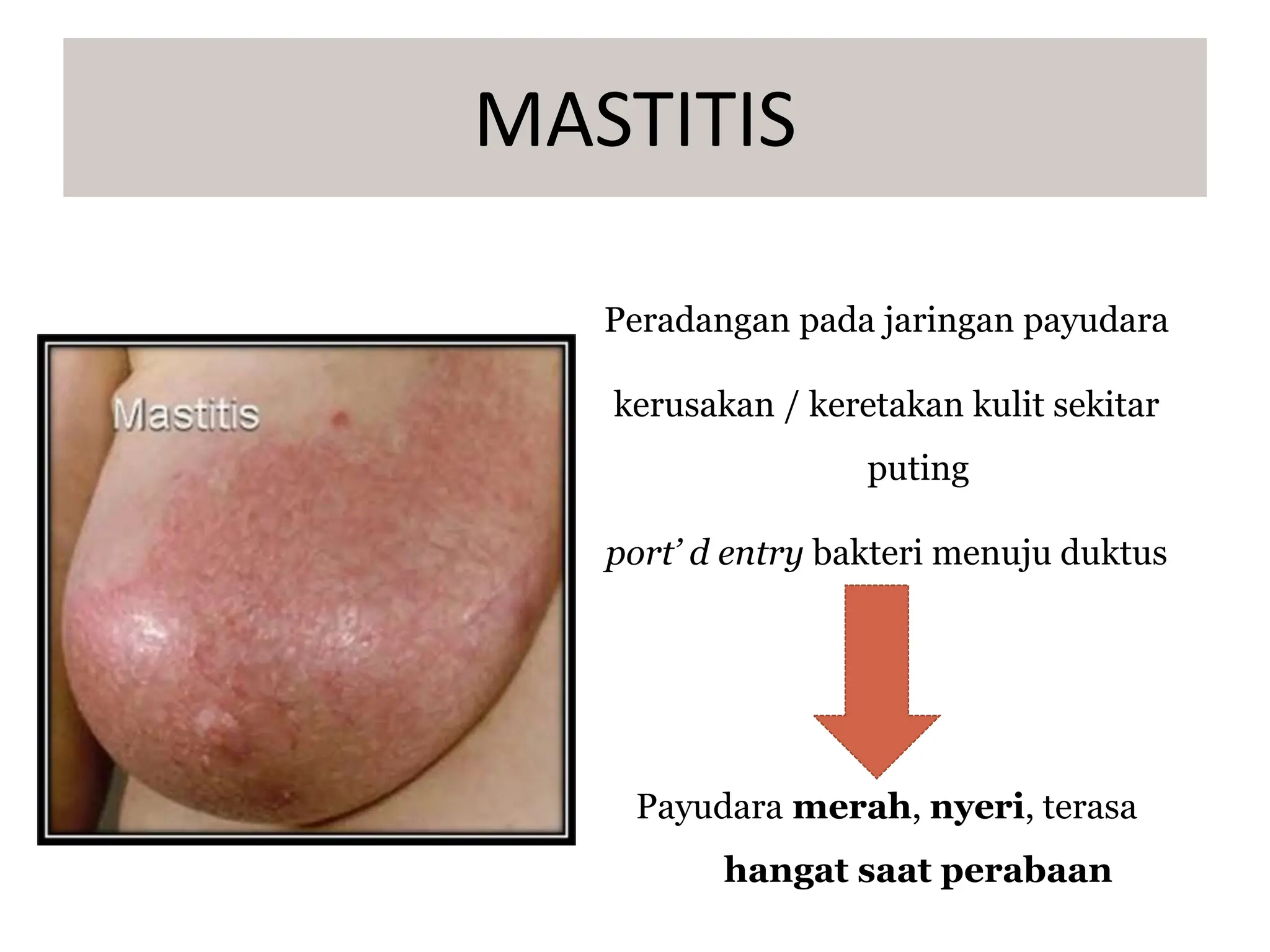Peradangan pada jaringan payudara
kerusakan / keretakan kulit sekitar
puting
port’ d entry bakteri menuju duktus
Payudara merah, nyeri, terasa
hangat saat perabaan
MASTITIS
 