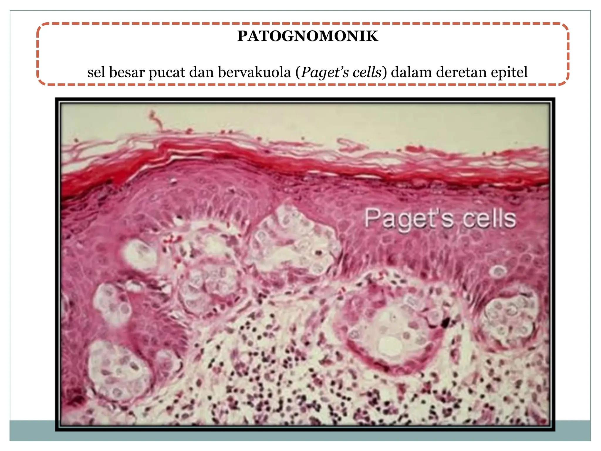 PATOGNOMONIK
sel besar pucat dan bervakuola (Paget’s cells) dalam deretan epitel
 