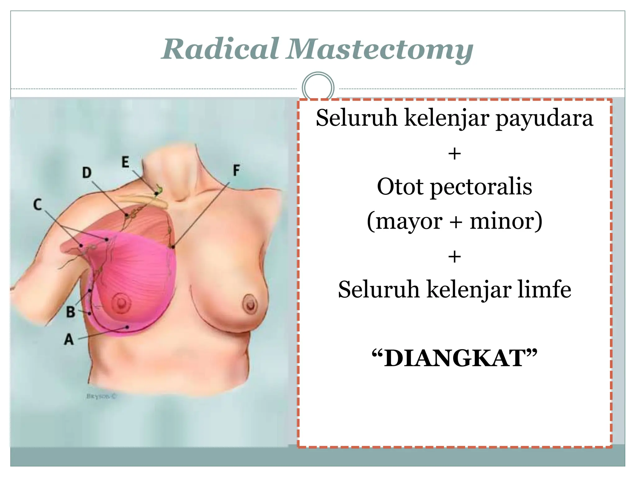Radical Mastectomy
Seluruh kelenjar payudara
+
Otot pectoralis
(mayor + minor)
+
Seluruh kelenjar limfe
“DIANGKAT”
 