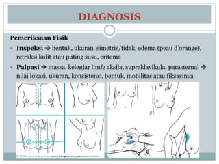 DIAGNOSIS
Pemeriksaan Fisik
 Inspeksi  bentuk, ukuran, simetris/tidak, edema (peau d’orange),
retraksi kulit atau puting susu, eritema
 Palpasi  massa, kelenjar limfe aksila, supraklavikula, parasternal 
nilai lokasi, ukuran, konsistensi, bentuk, mobilitas atau fiksasinya
 