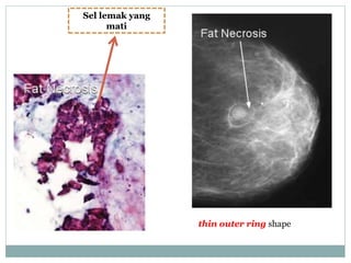 Sel lemak yang
mati
thin outer ring shape
 
