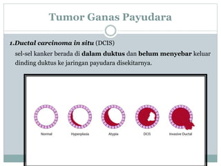 Tumor Ganas Payudara
1.Ductal carcinoma in situ (DCIS)
sel-sel kanker berada di dalam duktus dan belum menyebar keluar
dinding duktus ke jaringan payudara disekitarnya.
 