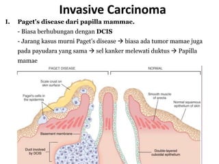 I. Paget’s disease dari papilla mammae.
- Biasa berhubungan dengan DCIS
- Jarang kasus murni Paget’s disease  biasa ada tumor mamae juga
pada payudara yang sama  sel kanker melewati duktus  Papilla
mamae
Invasive Carcinoma
 