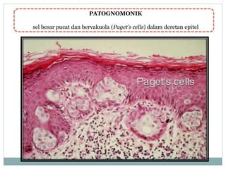 PATOGNOMONIK
sel besar pucat dan bervakuola (Paget’s cells) dalam deretan epitel
 