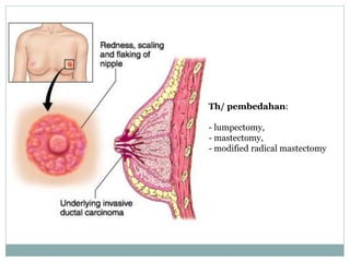 Th/ pembedahan:
- lumpectomy,
- mastectomy,
- modified radical mastectomy
 