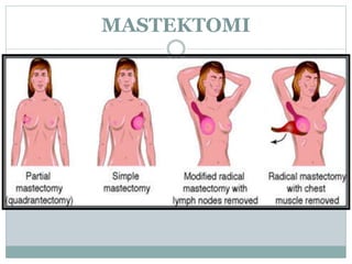 MASTEKTOMI
 