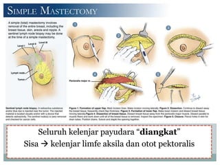 Seluruh kelenjar payudara “diangkat”
Sisa  kelenjar limfe aksila dan otot pektoralis
 