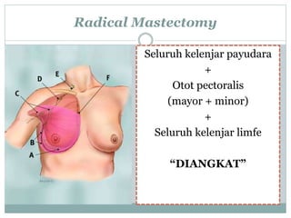 Radical Mastectomy
Seluruh kelenjar payudara
+
Otot pectoralis
(mayor + minor)
+
Seluruh kelenjar limfe
“DIANGKAT”
 