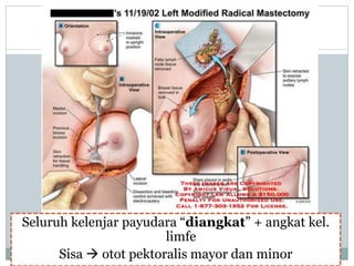 Seluruh kelenjar payudara “diangkat” + angkat kel.
limfe
Sisa  otot pektoralis mayor dan minor
 