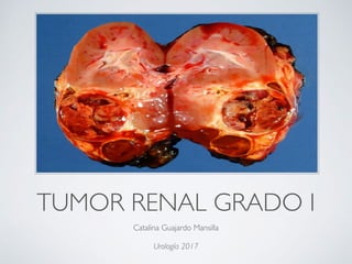 TUMOR RENAL GRADO I
Catalina Guajardo Mansilla
Urología 2017
 