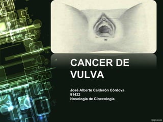 CANCER DE
VULVA
José Alberto Calderón Córdova
91432
Nosología de Ginecología
 