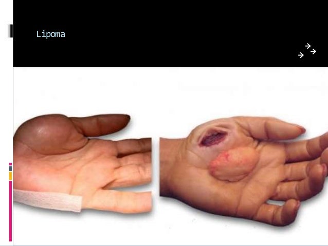 Tumors and tumorous conditions of the hand