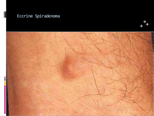 Tumors and tumorous conditions of the hand