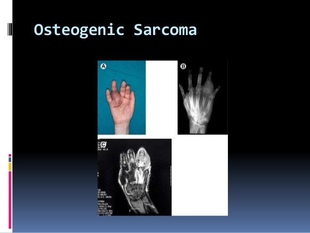 Tumors and tumorous conditions of the hand