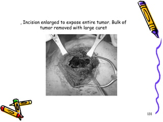 , Incision enlarged to expose entire tumor. Bulk of tumor removed with large curet131